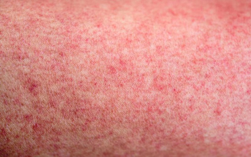 Triệu chứng của bệnh nhiễm trùng máu