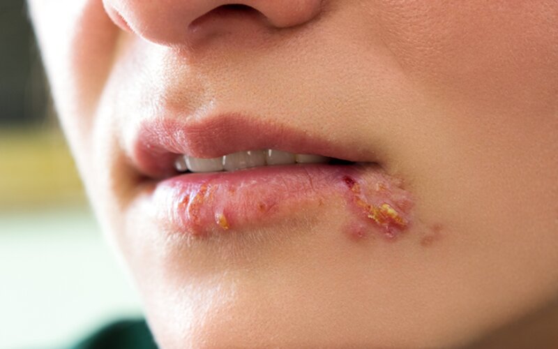 Herpes ở miệng