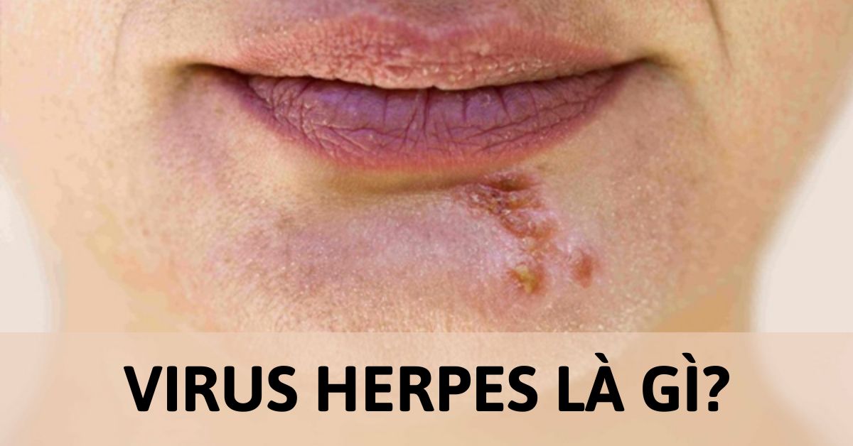 virus herpes là gì