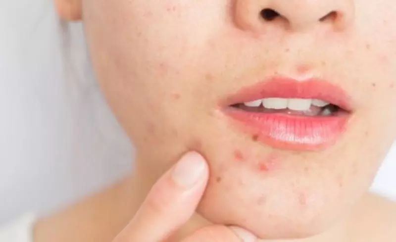 Trị mụn viêm do nhiễm khuẩn