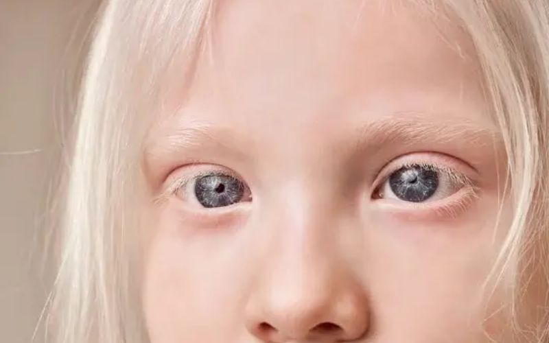 Bệnh bạch tạng thường có lượng melanin thấp hay thậm chí không có
