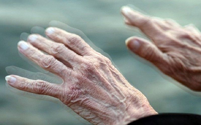 Bệnh Parkinson sẽ khiến neuromelanin trong não bộ bị giảm xuống
