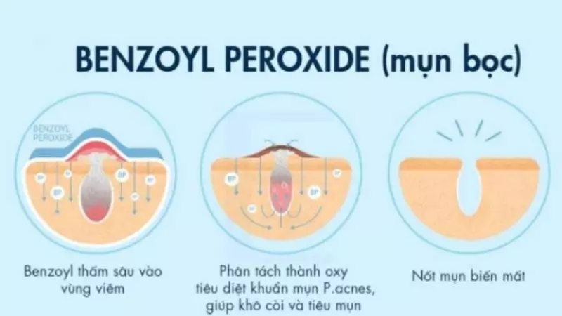 Benzoyl Peroxide