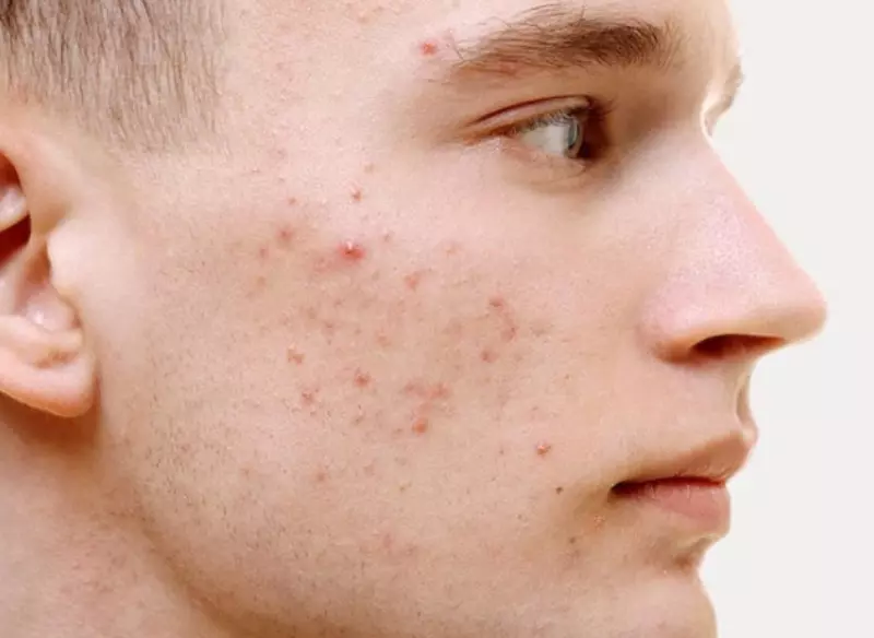 Dùng Benzoyl Peroxide cho hiệu quả