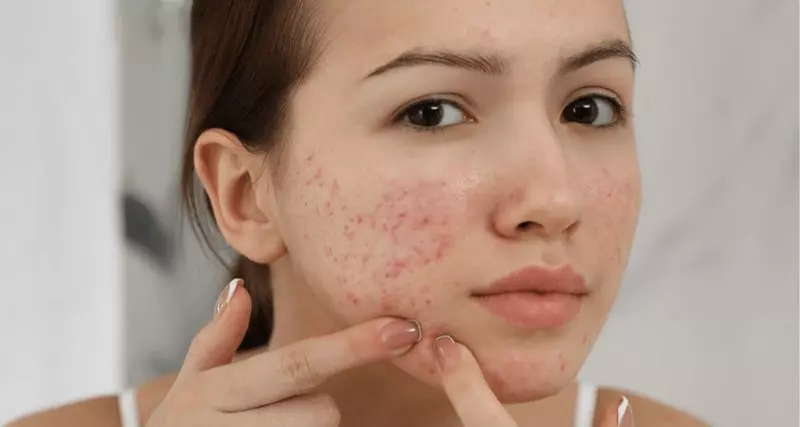 Hàm lượng Benzoyl Peroxide