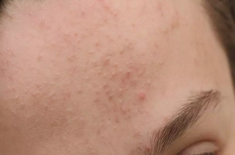 Glycolic Acid