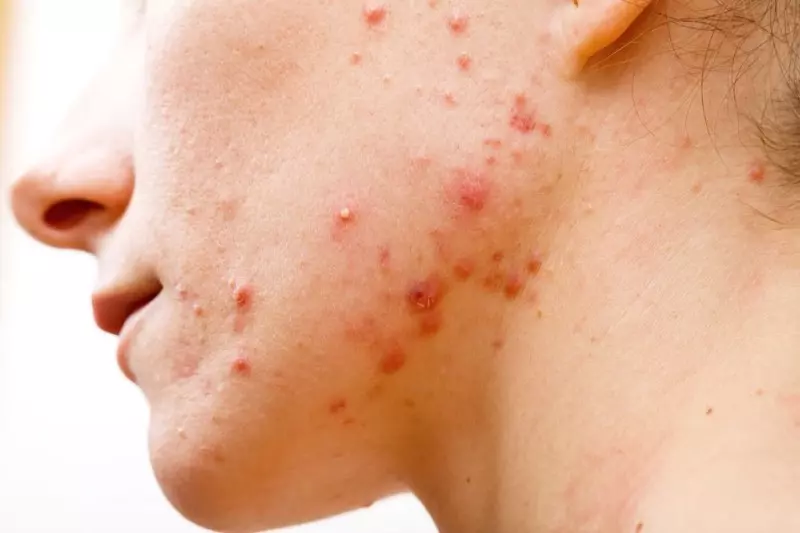 Tretinoin
