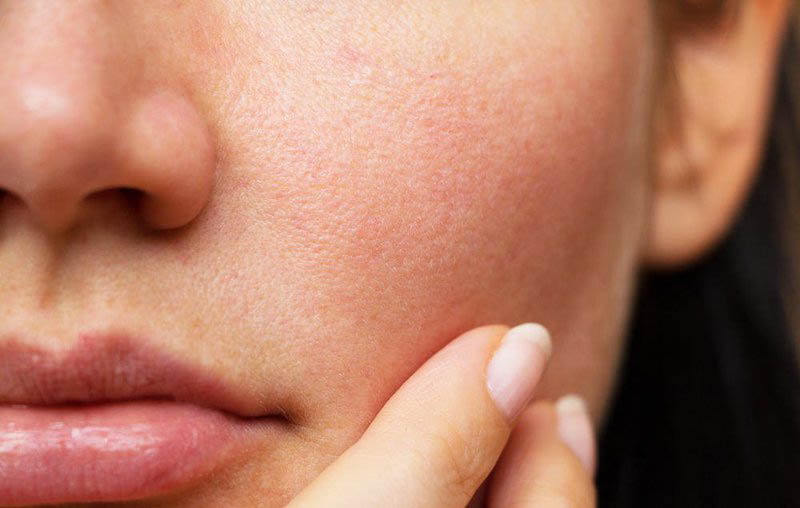 Cách nhận biết da khô