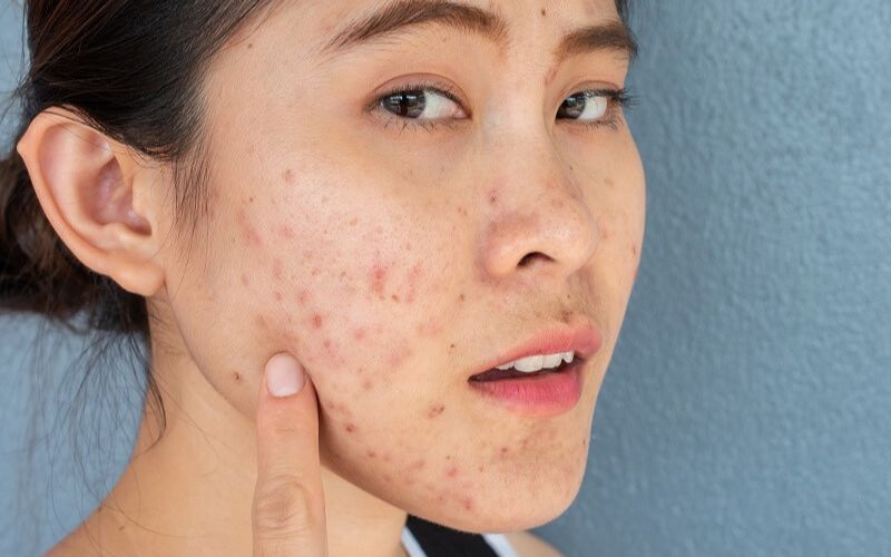 Cơ thể bị rối loạn sắc tố sẽ xảy ra tình trạng da không đều màu