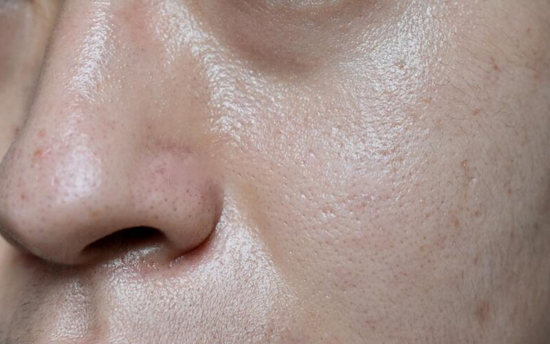 Da dầu có thể do di truyền từ đời này sang đời khác