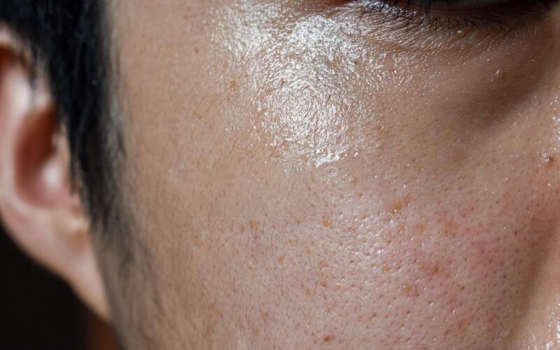 Môi trường sống nóng ẩm có thể dẫn đến da dầu