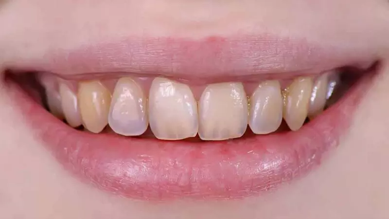 Cơ thể thừa Fluor phần men răng sẽ bị hủy hoại