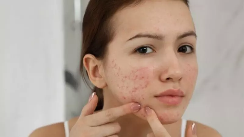 Mụn viêm sẽ làm bạn bị đau nhức