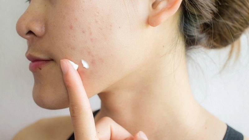 Có thể lựa chọn mỹ phẩm trị mụn