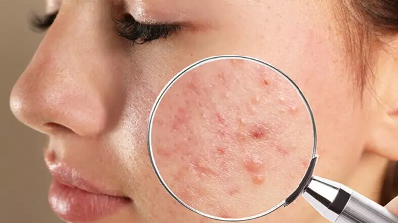 Bạn có thể nổi mụn do di truyền