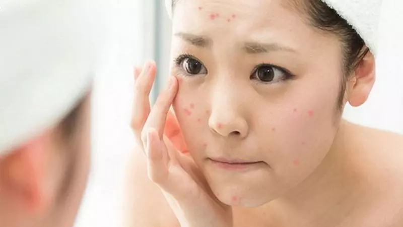 Có rất nhiều nguyên nhân dẫn đến mụn