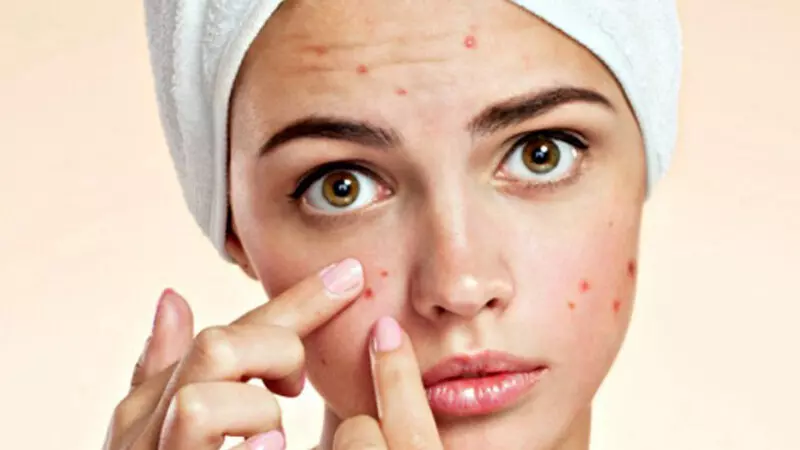 Mụn viêm đỏ là loại mụn dễ trị nhất