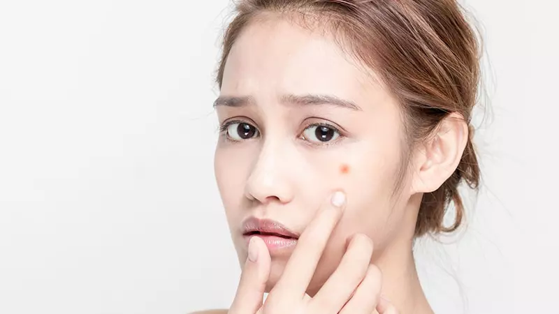 Đừng tự ý nặn mụn tại nhà