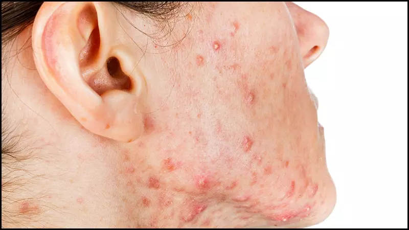 Loại mụn nặng nhất là mụn nang