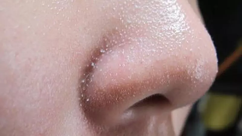 Tuyến bã nhờn thường có ở mặt và da đầu