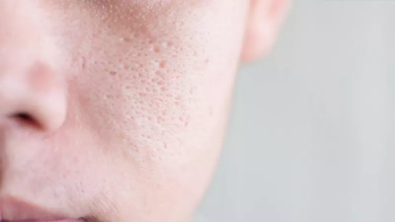 Lỗ chân lông bị tắc nghẽn cũng gây nên mụn