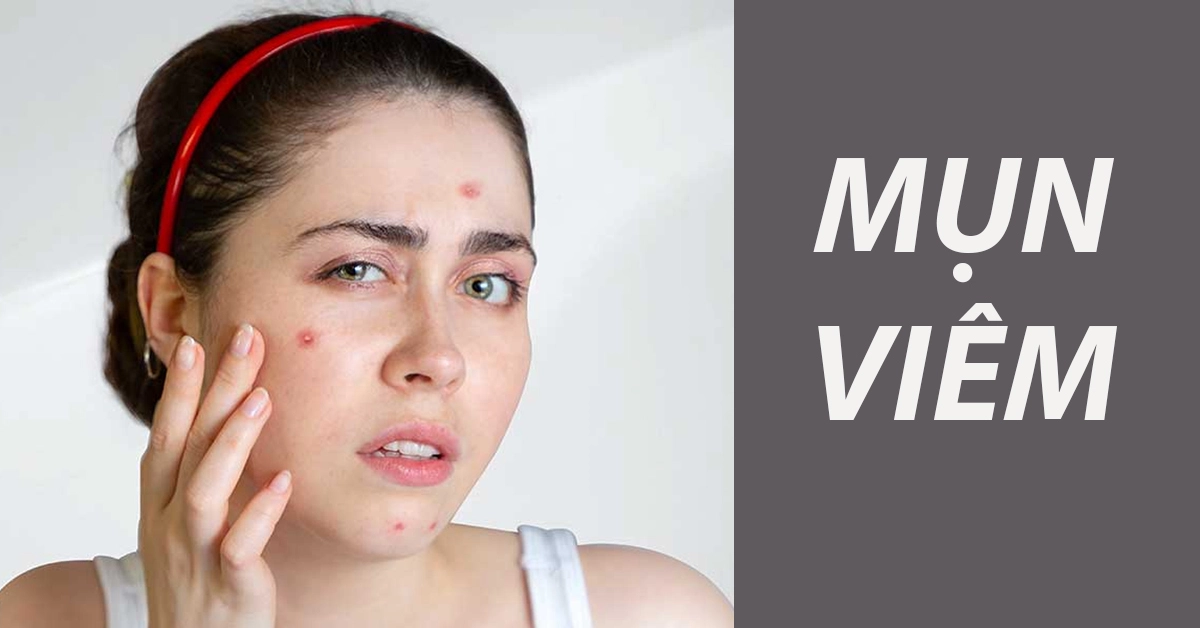 mụn viêm