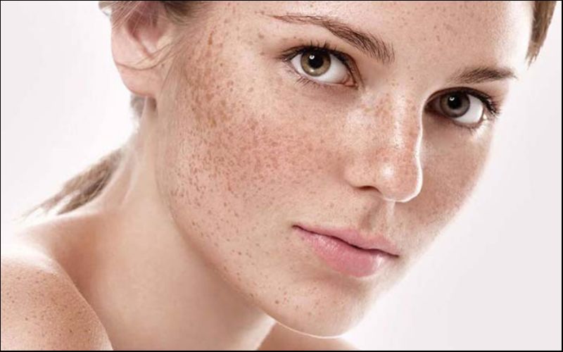 Nám xuất hiện trên da là các đốm nâu hay vết sám đen trên da