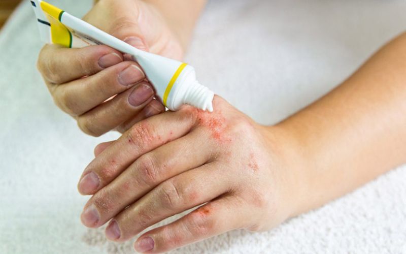 Sử dụng kem bôi điều trị