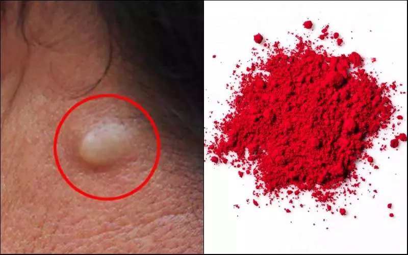 Màu đỏ số 3 đã bị FDA cấm một phần bởi nó làm tăng nguy cơ ung thư tuyến giáp