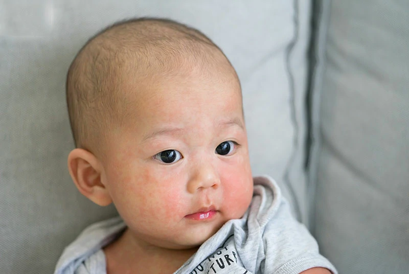 Dị ứng đạm sữa bò là gì?