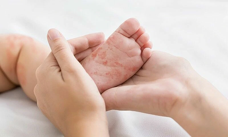 Cách nhận biết trẻ bị dị ứng đạm sữa bò