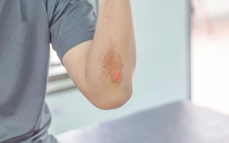 Hỗ trợ làm lành vết thương