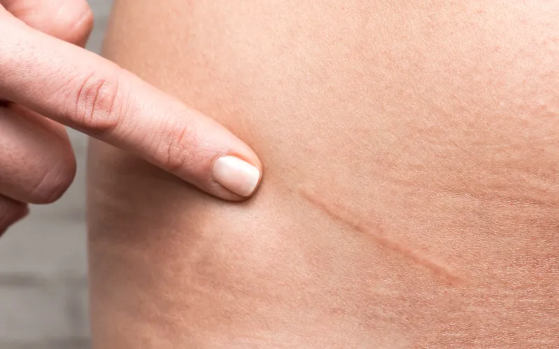 Cấu trúc elastin bị phá vỡ sẽ hình thành sẹo