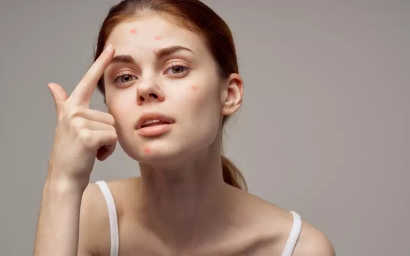 Ngăn ngừa và hỗ trợ điều trị mụn