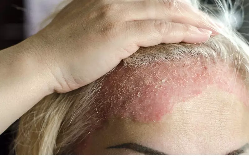 Làm dịu tình trạng bệnh vẩy nến