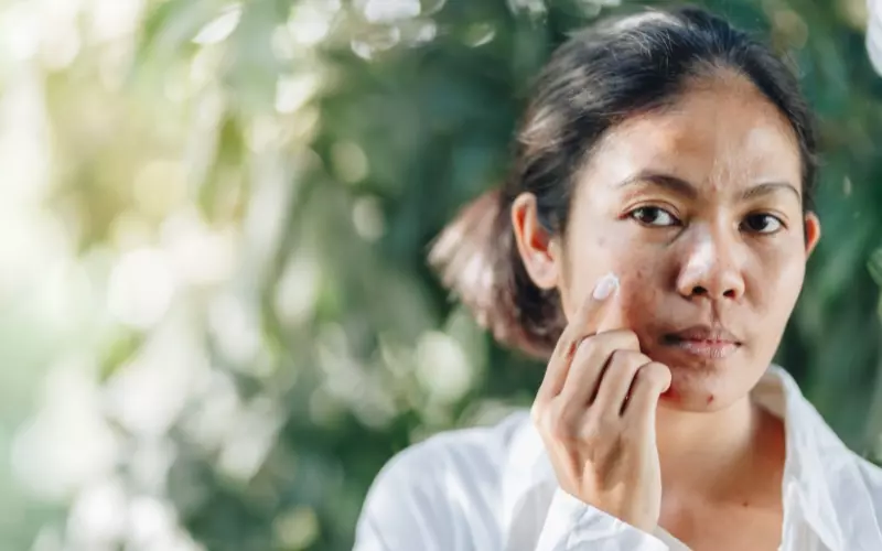 Trị mụn trứng cá