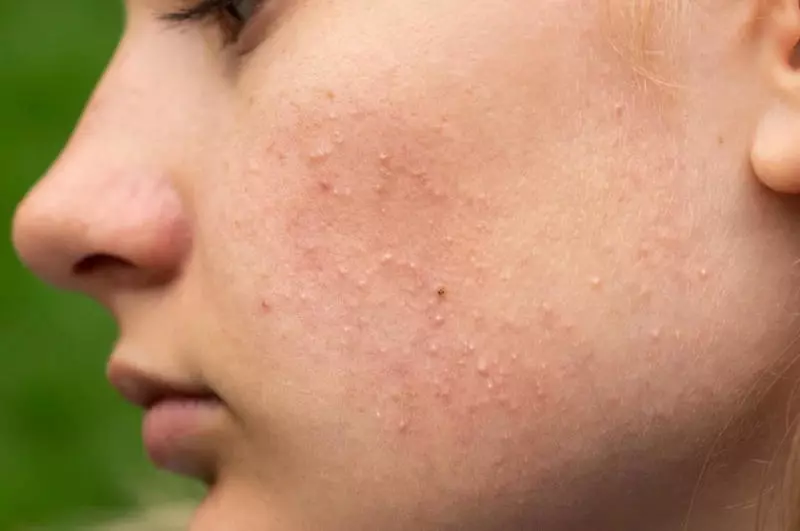 Dấu hiệu nhận biết mụn ẩn