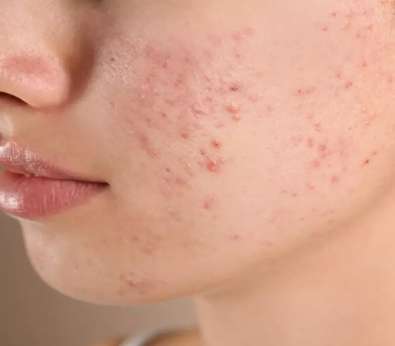 Niacinamide giúp đánh tan mụn viêm