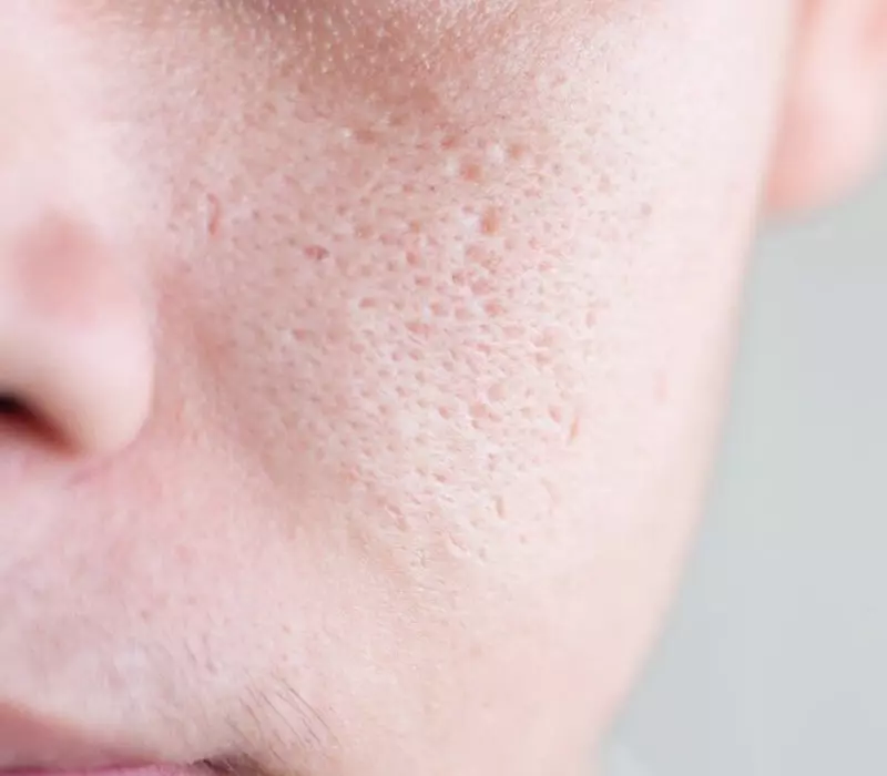 Niacinamide giúp thu nhỏ lỗ chân lông