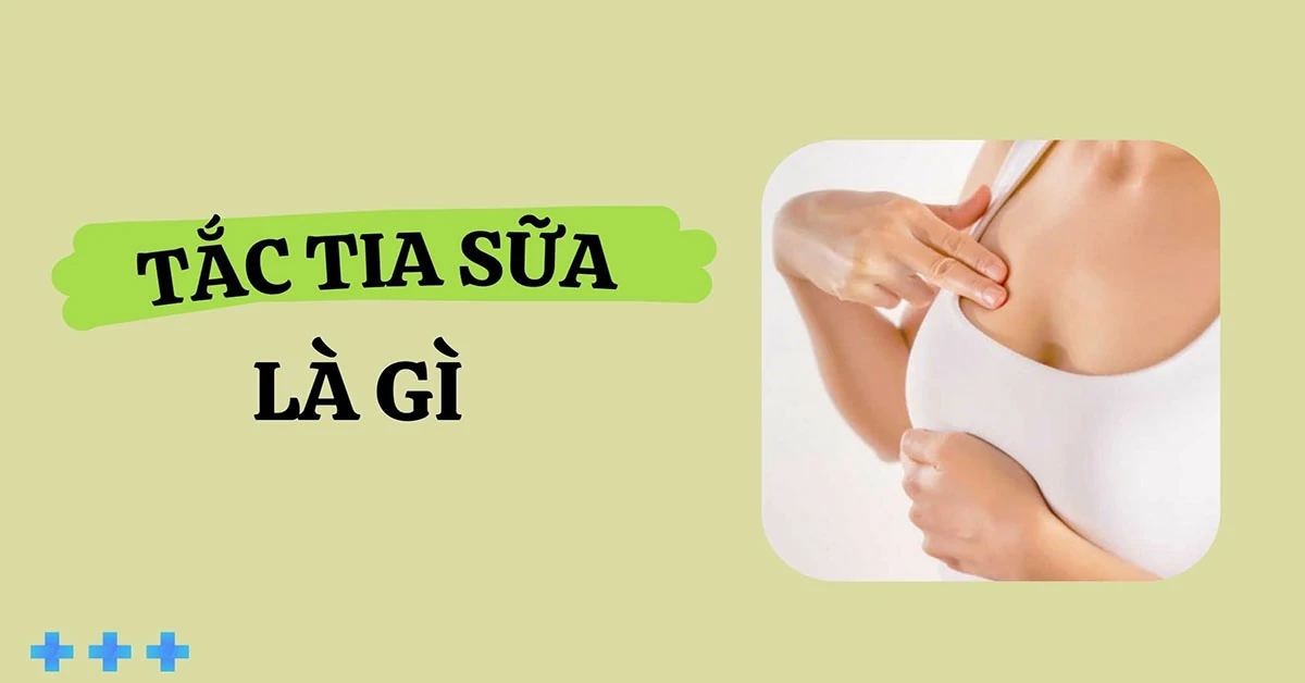 tắc tia sữa là gì