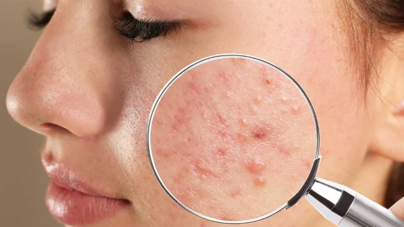 Tác dụng của Tretinoin