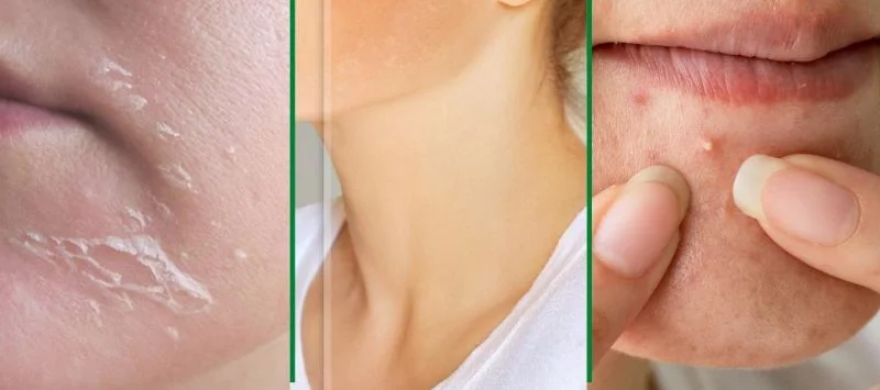 Tác dụng của Tretinoin