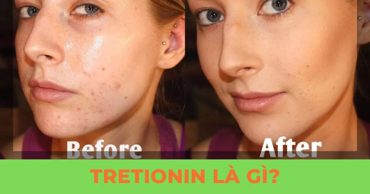 tretinoin là gì