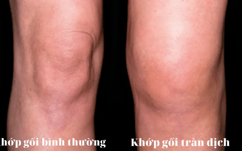 Tràn dịch khớp gối