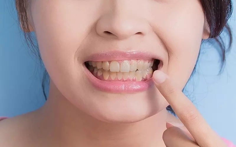 Đôi khi bạn bị vàng răng là vì di truyền
