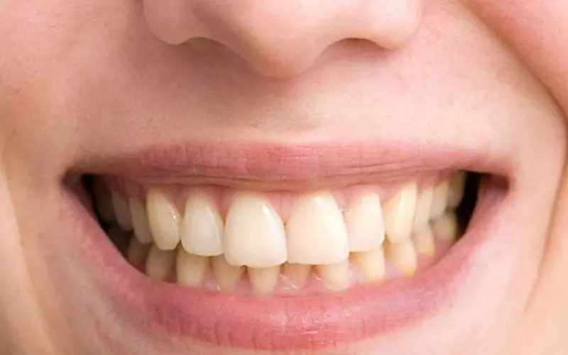 Trẻ em là nhóm đối tượng dễ bị vàng răng khi nhiễm fluor