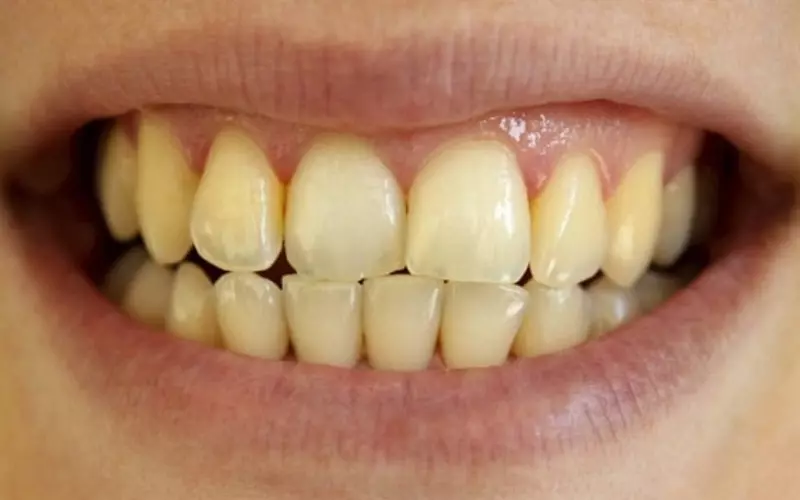 Nên bổ sung một vài món ăn để tránh tình trạng răng bị ố vàng