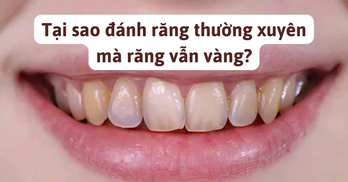 tại sao đánh răng thường xuyên mà răng vẫn vàng
