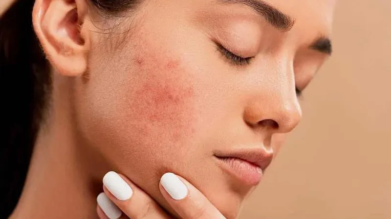 Tẩy tế bào chết hỗ trợ quá trình điều trị mụn