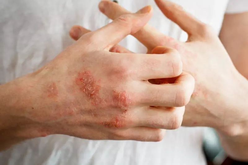 Điều trị bệnh Pellagra